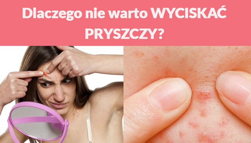 Dlaczego nie warto WYCISKAĆ PRYSZCZY?
