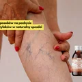 10 genialnych metod na pozbycie się żylaków w naturalny sposób!