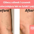 Oliwa z oliwek i czosnek - najskuteczniejszy lek na żylaki i pajączki. Sprawdź jak to zrobić