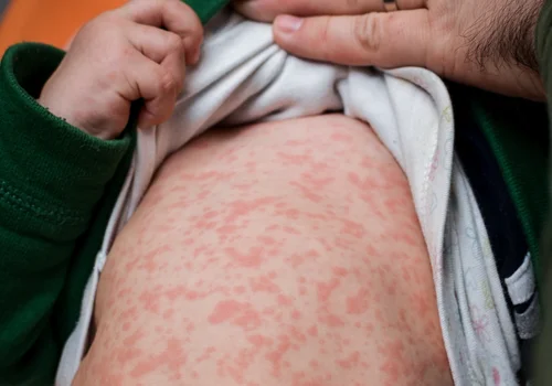 Groźna choroba zakaźna wraca do Polski i Europy! Powikłania bywają koszmarne!