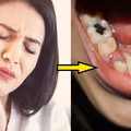 Masz problem z próchnicą? Dowiedz się, jak możesz się jej pozbyć domowymi sposobami!