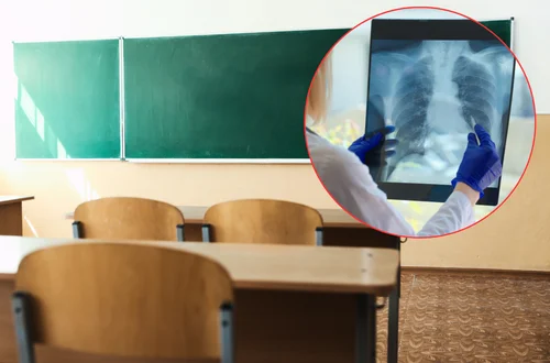 Potwierdzony przypadek gruźlicy w polskiej szkole! Setki dzieci i dorosłych zagrożonych - Sanepid rozpoczął procedury