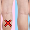 HIT medycyny naturalnej! Zniweluj cellulit, pajączki oraz żylaki. Sprawdź koniecznie!