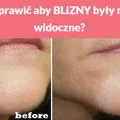 Jak sprawić aby BLIZNY były mniej widoczne?
