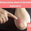 Wykorzystaj aloes w leczeniu łuszczycy