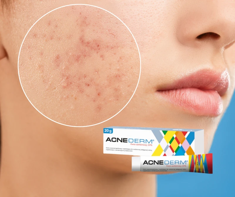Hit z apteki za 18 zł na przebarwienia i tłustą cerę! Zaskakujące właściwości Acne-derm!