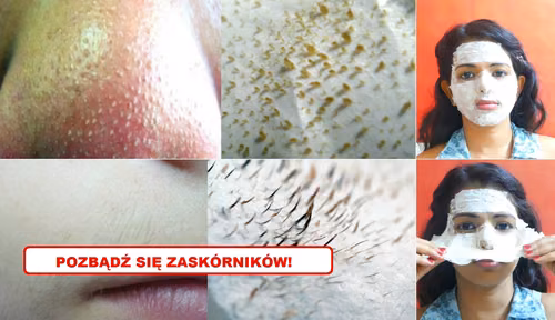 Poznaj 2 najlepsze sposoby na ZASKÓRNIKI
