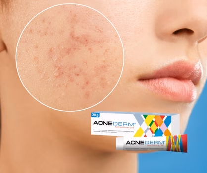 Hit z apteki za 18 zł na przebarwienia i tłustą cerę! Zaskakujące właściwości Acne-derm!