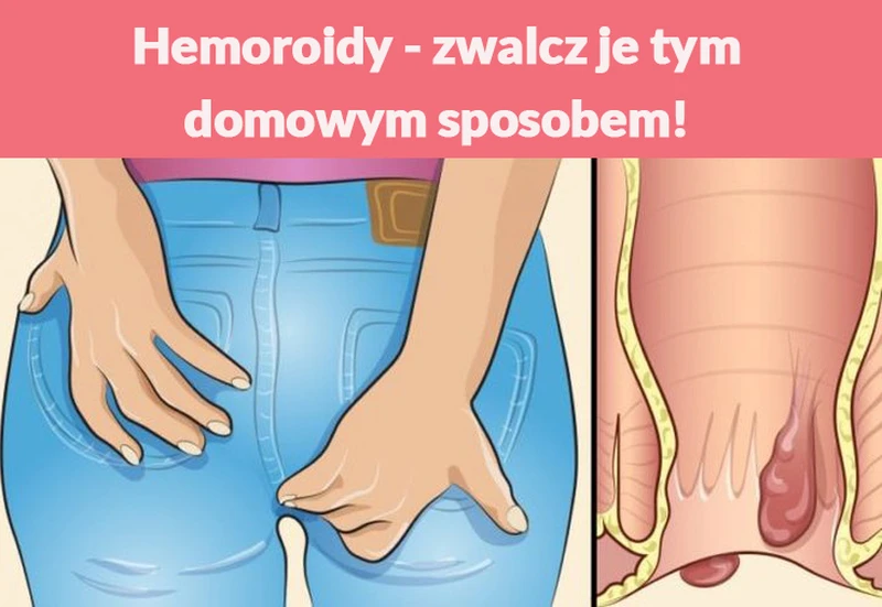 Hemoroidy - zwalcz je tym domowym sposobem!