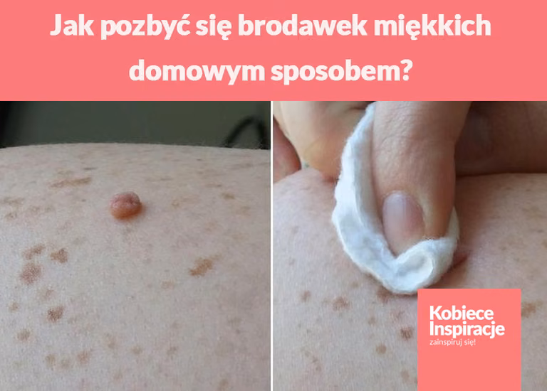 Jak pozbyć się brodawek miękkich domowym sposobem?