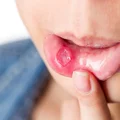 Afty na języku, wardze, w gardle. Skąd się biorą afty?