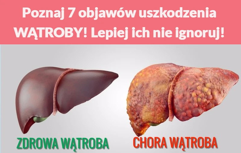 Poznaj 7 objawów uszkodzenia WĄTROBY! Lepiej ich nie ignoruj!
