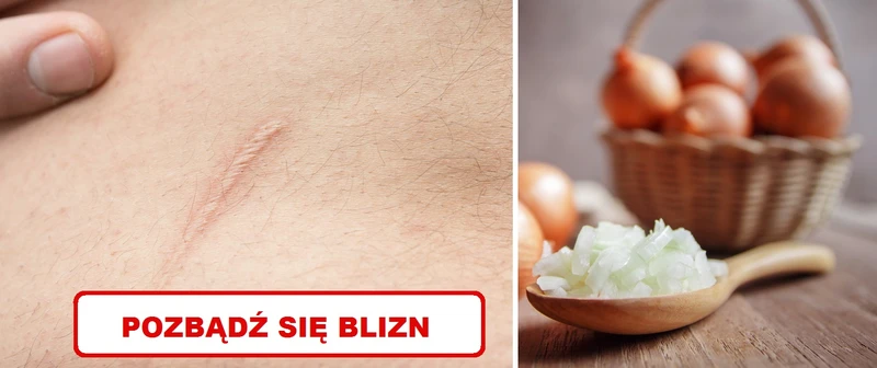 Wykorzystaj właściwości CEBULI i zmniejsz widoczność BLIZN!