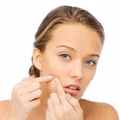 Wykorzystaj OCET jabłkowy przy usuwaniu pryszczy!