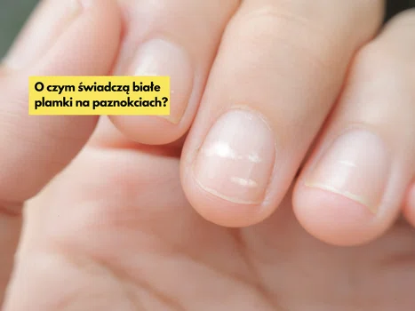 O czym świadczą białe plamki na paznokciach? Sprawdź, czy sama ich nie masz!