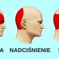 Pozbądź się BÓLU GŁOWY w 5 minut bez TABLETEK!
