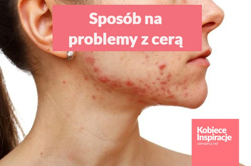Przewlekły lęk i stres, a problemy z cerą
