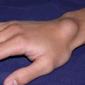 Ganglion – guz na nadgarstku. Jakie mogą być jego skutki?