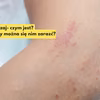 Masz takie znamię na skórze? Sprawdź czym jest liszaj i jak go wyleczyć?