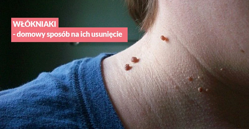 Każdy z Nas ma przynajmniej jednego - WŁÓKNIAKI - Jak je usunąć?