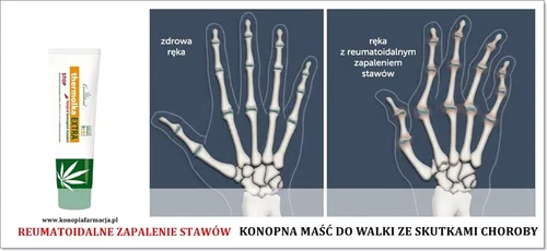 Światowy Dzień Reumatyzmu 12 październik - Reumatyzm jak opnanować stan zapalny