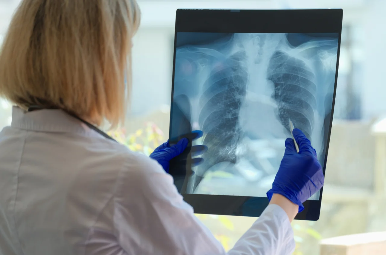 Światowy Dzień Gruźlicy: Walka z Jedną z Najstarszych Chorób Zakaźnych