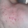 Co jest przyczyną występowania pryszczy w różnych miejscach na ciele?