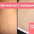 Jak walczyć z rozstępami? Pomoże Ci w tym kawa i oliwa z oliwek