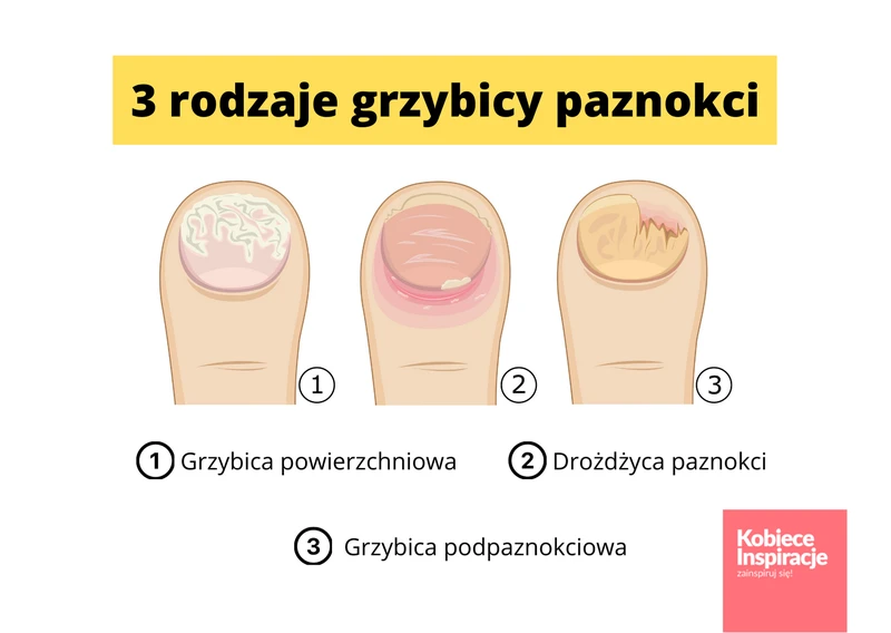 Jak rozpoznać rodzaj grzybicy paznokci?