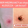 RUMIEŃ WĘDRUJĄCY po ukąszeniu KLESZCZA – jak leczyć?