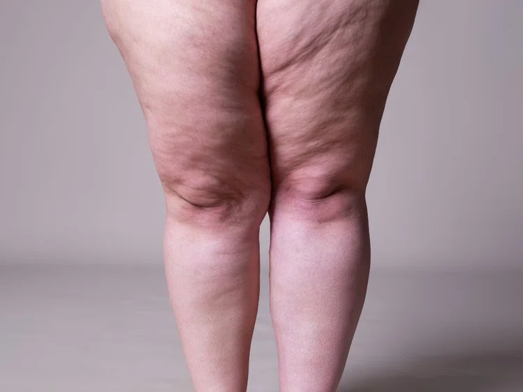 Zdjęcie Lipodemia, czyli choroba grubych nóg. Jakie są przyczyny i jak ją leczyć? #1