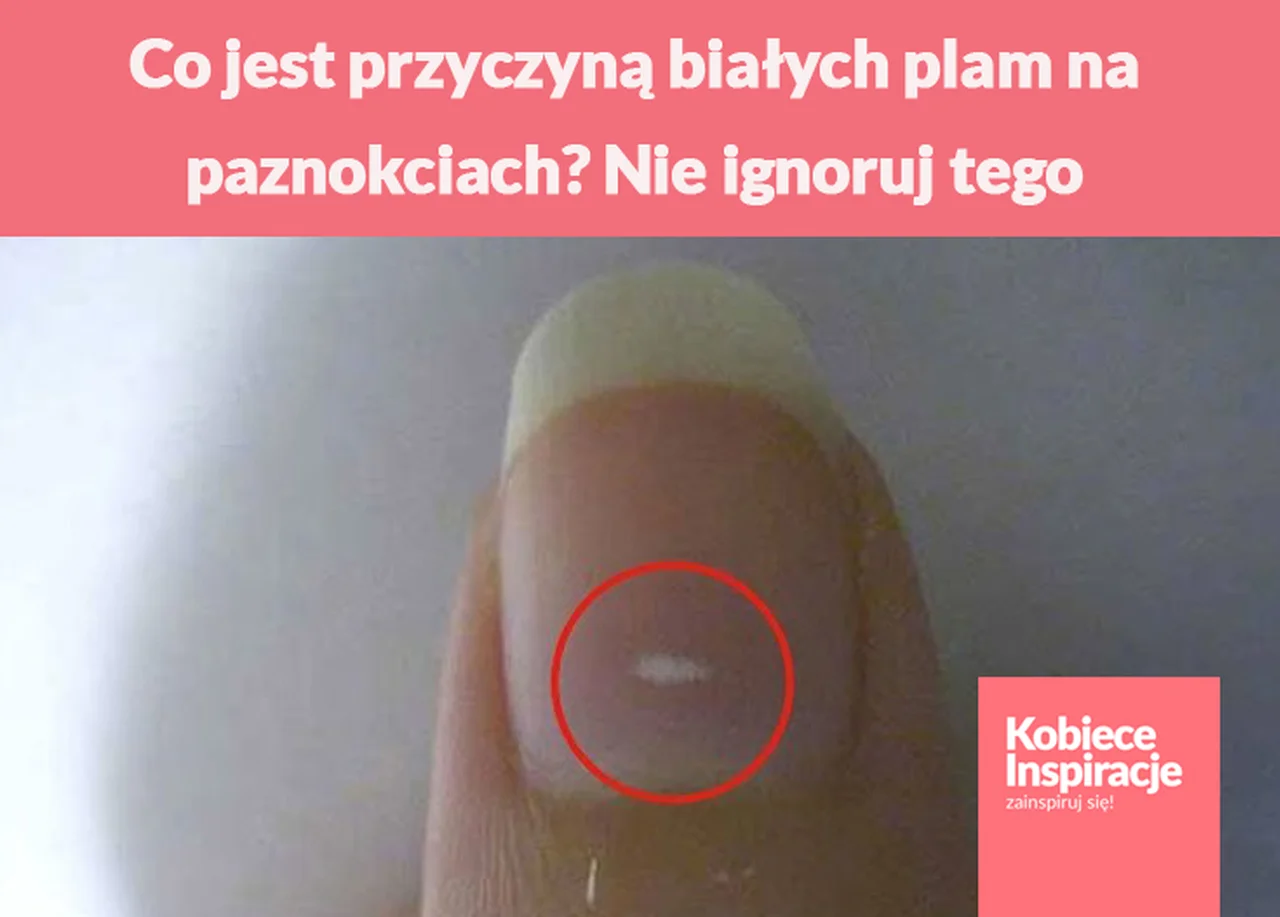 Co jest przyczyną białych plam na paznokciach? Nie ignoruj tego