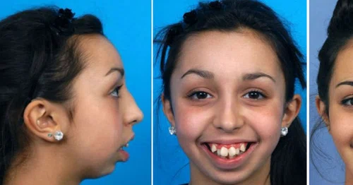 Dziewczyna z niewiarygodnie krzywymi zębami przeszła przez piekło. Dziś już tak nie wygląda