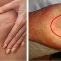 Czy wiesz, że cellulit i cellulitis to dwie zupełnie różne rzeczy? Poznaj różnice