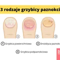 Jak rozpoznać rodzaj grzybicy paznokci?