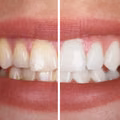 Biały uśmiech bez wizyty u dentysty? Odkryj sekretny składnik z Twojej kuchni!