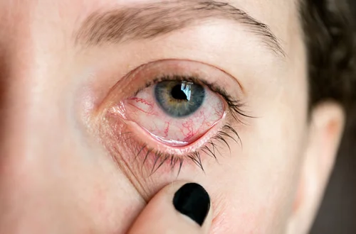 Czy zapaleniem spojówek można się zarazić? Oto, co musisz wiedzieć o "różowym oku"!