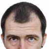 Jak zapobiec łysieniu?