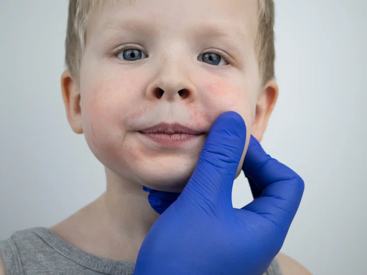 Zdjęcie Jak rozpoznać alergię u dziecka? Jak wygląda leczenie? #2