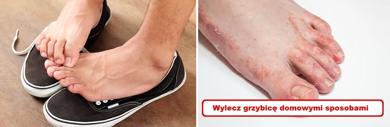 GRZYBICA? Wypróbuj naturalne sposoby!