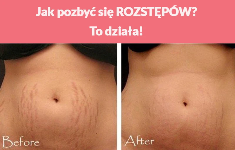 Jak pozbyć się ROZSTĘPÓW?
