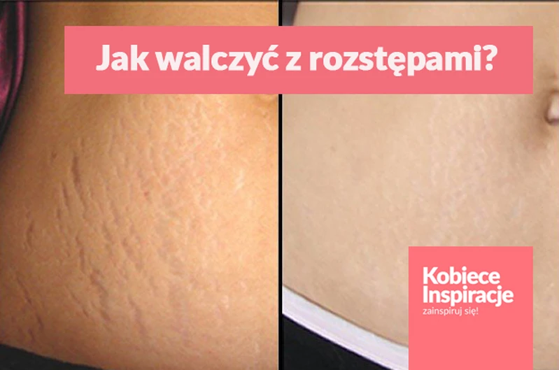 Jak walczyć z rozstępami? Pomoże Ci w tym kawa i oliwa z oliwek