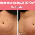 Jak pozbyć się ROZSTĘPÓW?