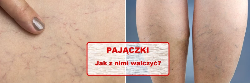 Zauważyłaś na swoim ciele tzw PAJĄCZKI? Pozbądź się ich domowym sposobem