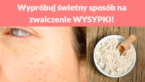 Wypróbuj świetny sposób na zwalczenie WYSYPKI!