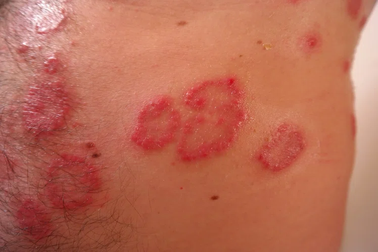 Zdjęcie Atopowe zapalenie skóry- przyczyny, objawy i leczenie #2