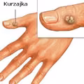 Jak pozbyć się kurzajek domowym sposobem?