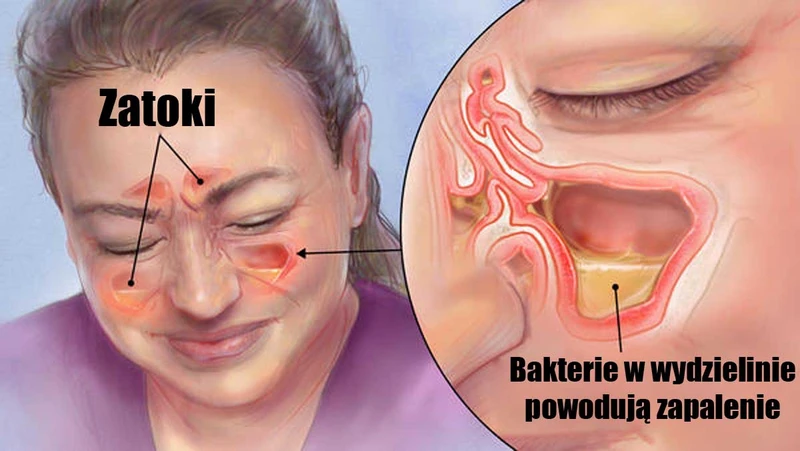 Najlepszy sposób na ZAPALENIE ZATOK - domowa kuracja