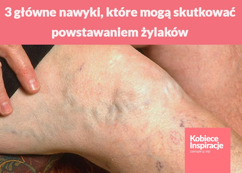 3 główne nawyki, które mogą skutkować powstawaniem żylaków. Większość z nas sama się o nie prosi..