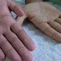 Często masz zimne ręce? To może być objaw choroby – sprawdź, na co zwrócić uwagę!